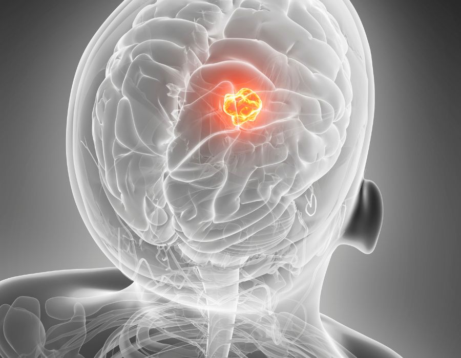 Symptoms of Brain Cancer