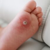 what are warts