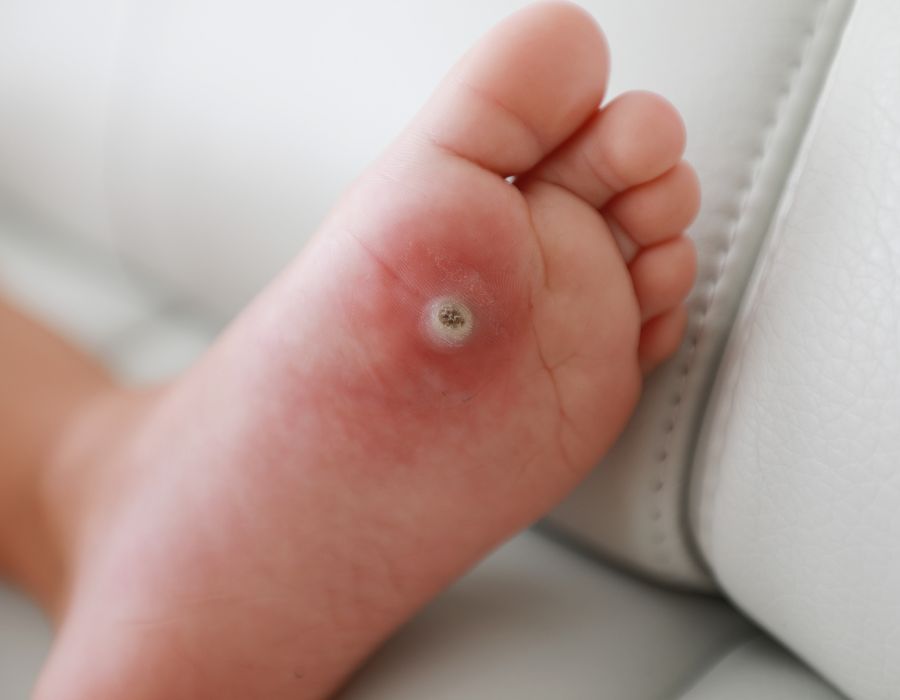what are warts